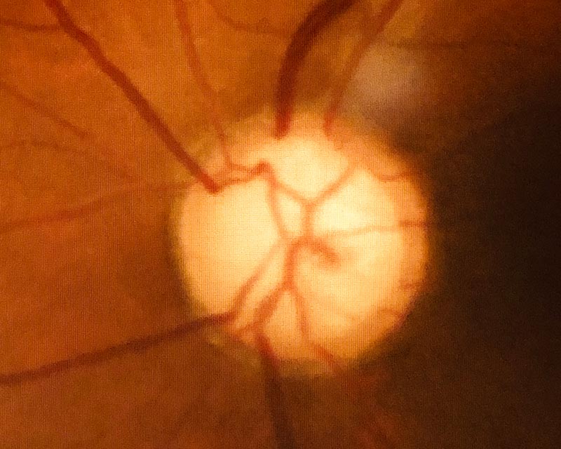 Glaucome