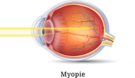 Myopie