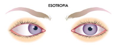 Esotropia