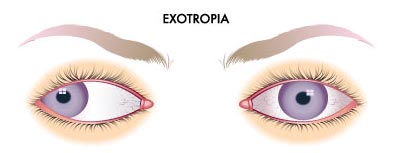 Exotropia